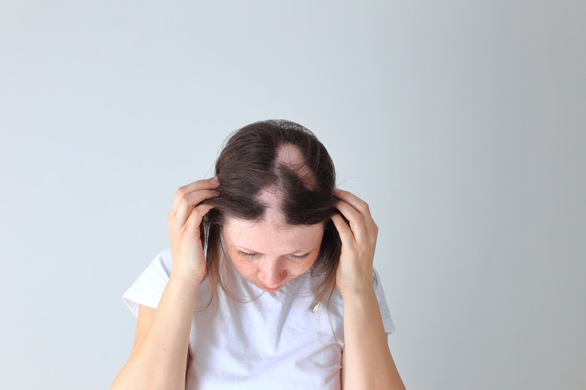 ALOPECIA AREATA